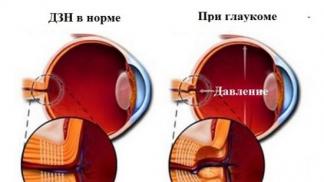 Причины появления гипоплазии зрительного нерва Гипоплазия макулы у детей лечение